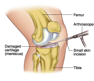 Arthroscopic Surgery Arthroscopic Surgery