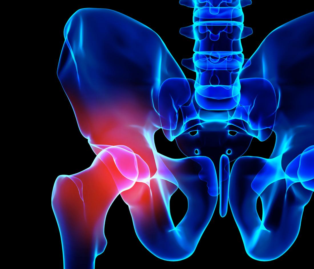 Hip Replacement Hip Replacement